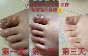 小姑娘甲沟炎化脓后涂抹醋蛋液的效果！